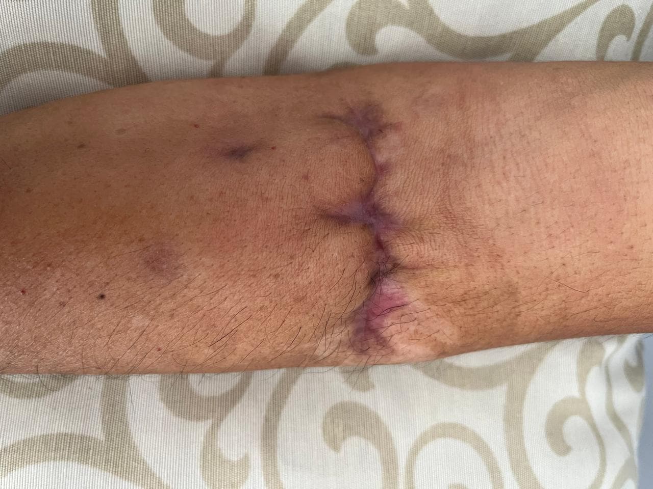 Caso Cicatrización real de Fisioderma — después
