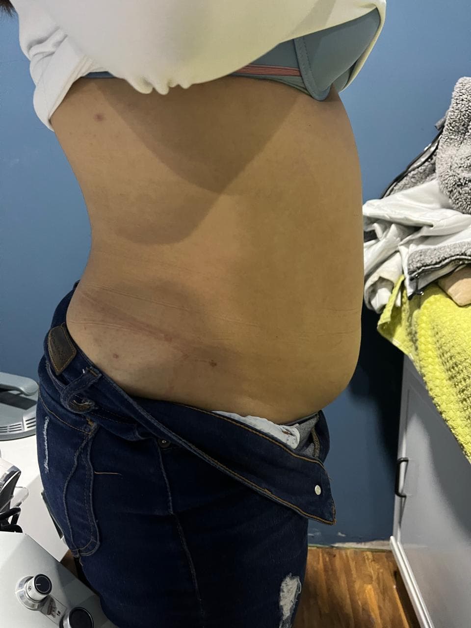 Caso Corporal real de Fisioderma — antes