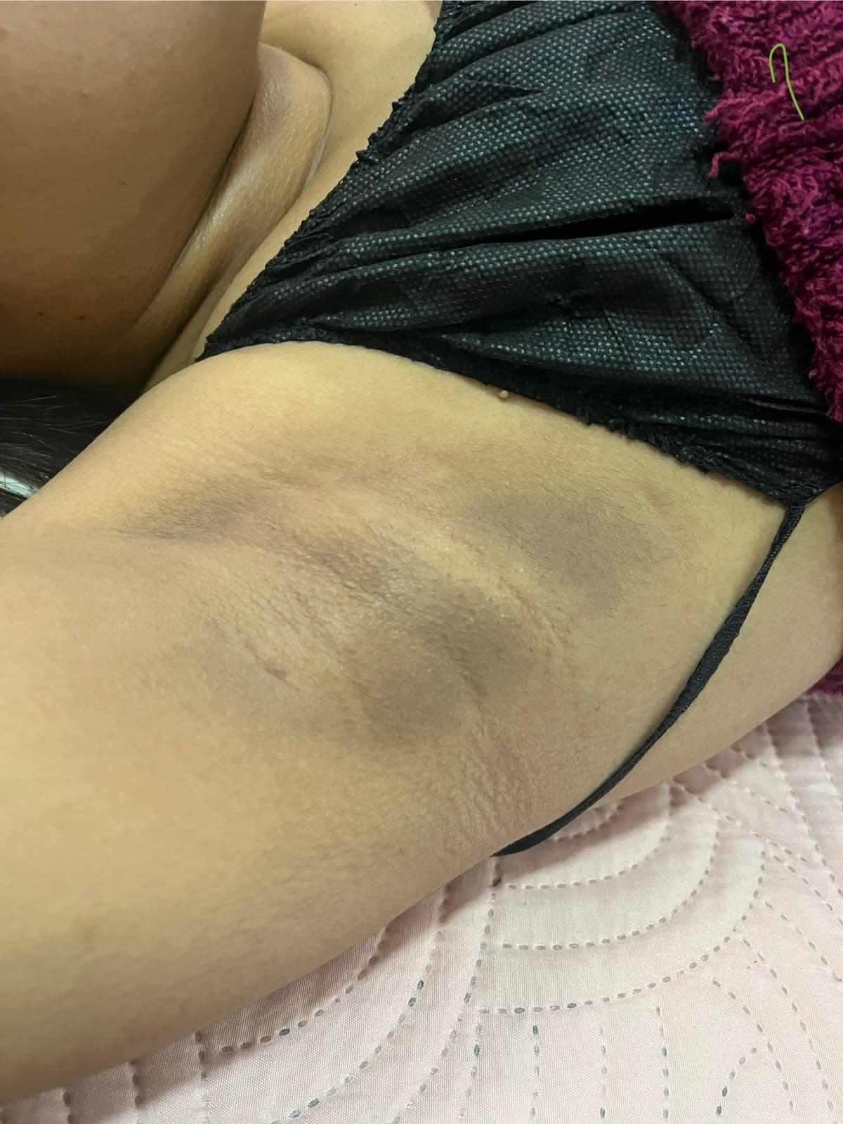 Caso Dermatofuncional real de Fisioderma — antes