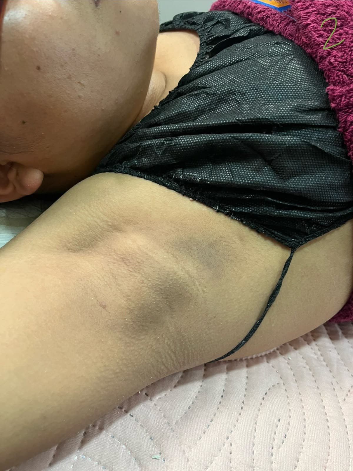Caso Dermatofuncional real de Fisioderma — después