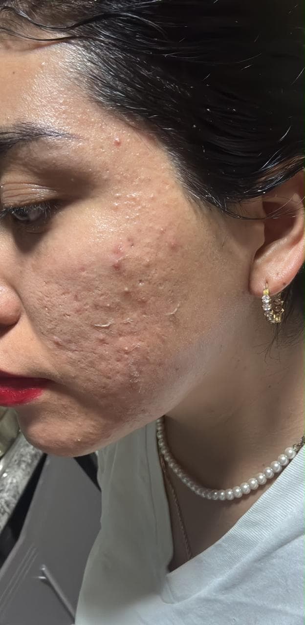 Caso facial real de Fisioderma — antes