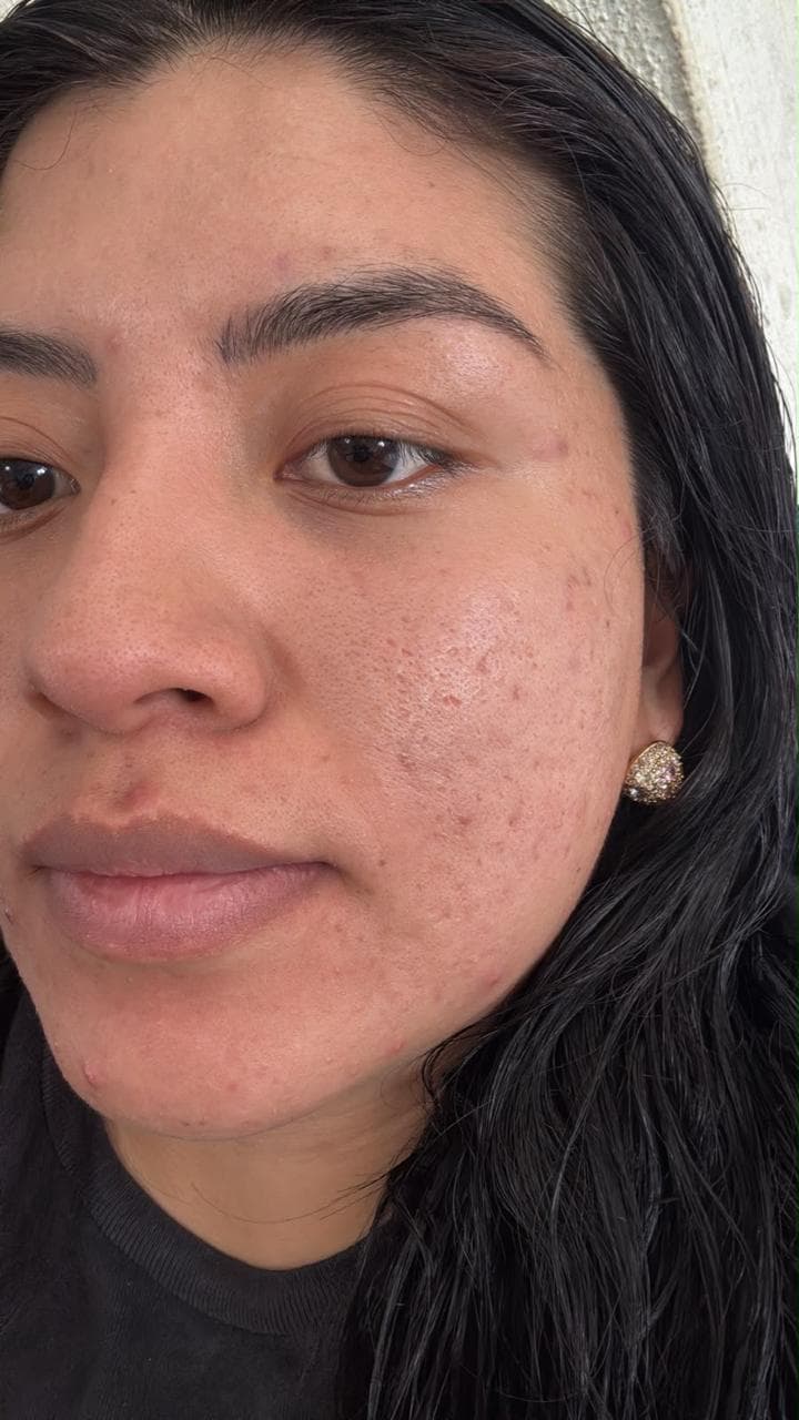 Caso facial real de Fisioderma — después